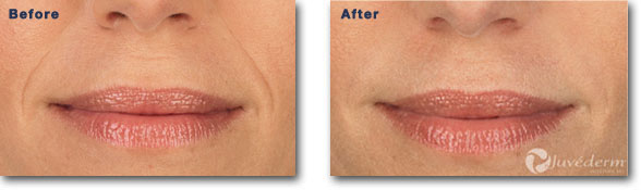 before & after dermal filler