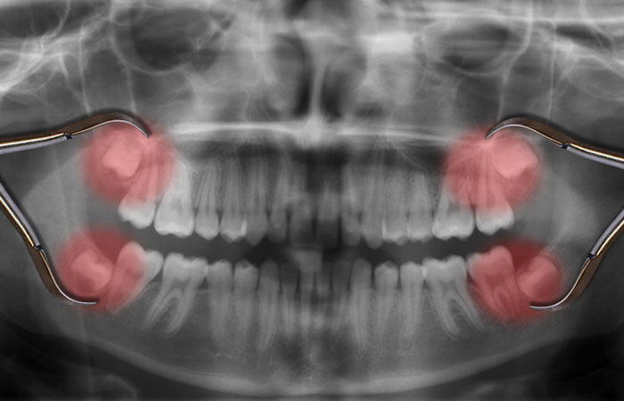 xray showing wisdom teeth