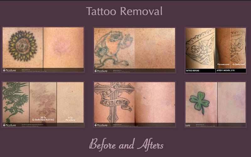 before and after tattoo removal
