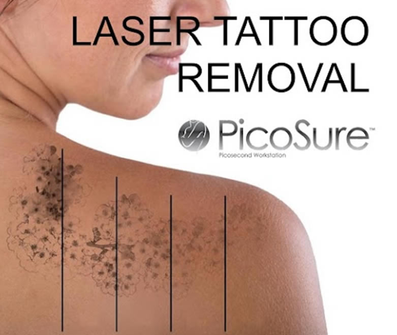 laser tattoo removal