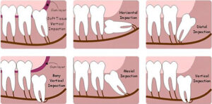 Wisdom teeth removal