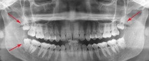 wisdom teeth xray