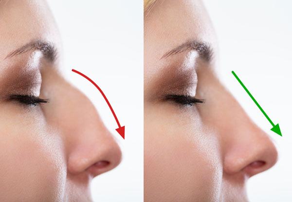 example of nose surgery