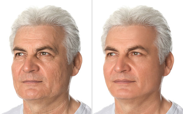 before/after older man with facelift