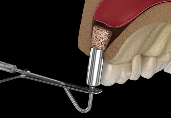 sinus lift illustration